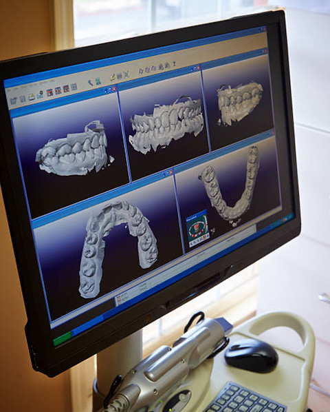 A 3D scan of a patient’s teeth on the screen of an intraoral scanner